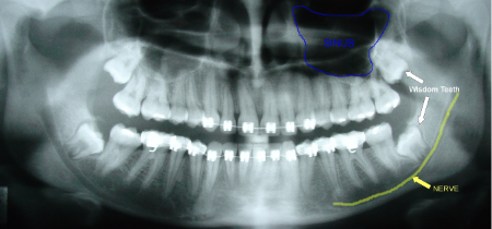 3D molar film