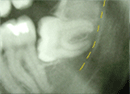 Horizontal impaction 