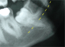 wisdom tooth roots 
